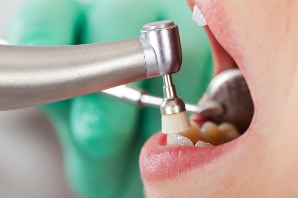 ¿Cada cuánto tiempo se recomienda realizar una limpieza dental?