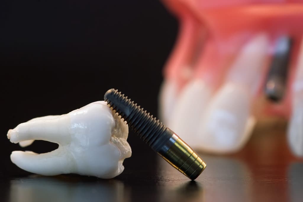 ¿Qué son y para qué sirven los implantes dentales?