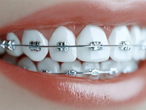 5 consejos para aliviar las molestias durante los primeros días de ortodoncia
