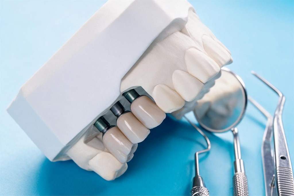 6 pasos del proceso de osteointegración que debe conocer