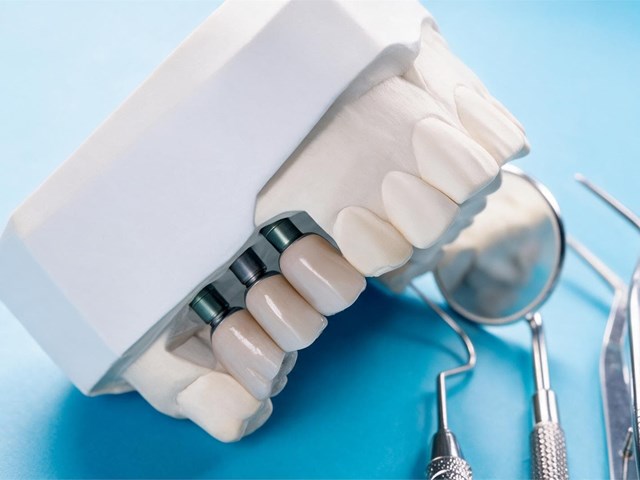 6 pasos del proceso de osteointegración que debe conocer