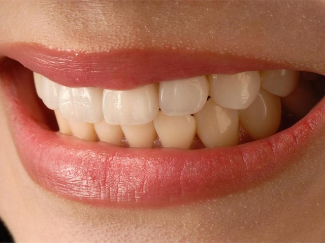 ¿Cada cuánto tiempo debo hacerme una limpieza dental?