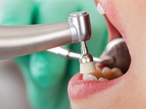 ¿Cada cuánto tiempo se recomienda realizar una limpieza dental?