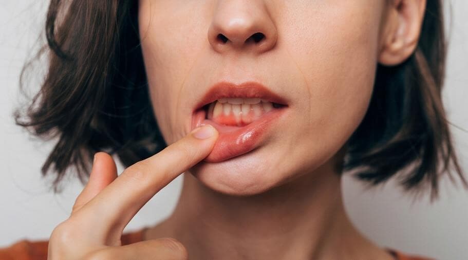 ¿Cómo diferenciar las molestias de encías sensibles a un caso de enfermedad gingival?