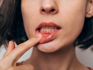 ¿Cómo diferenciar las molestias de encías sensibles a un caso de enfermedad gingival?