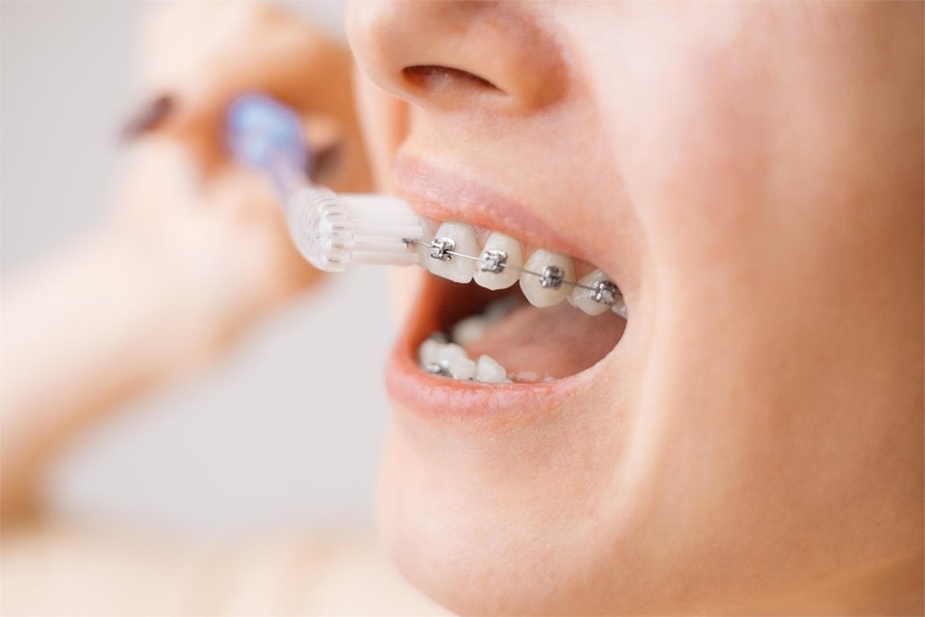 Consejos para lavar los dientes con brackets