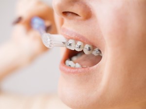 Consejos para lavar los dientes con brackets