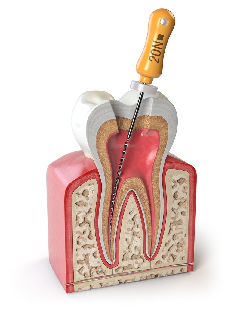¿Cuándo es necesaria una endodoncia y cuáles son sus beneficios?