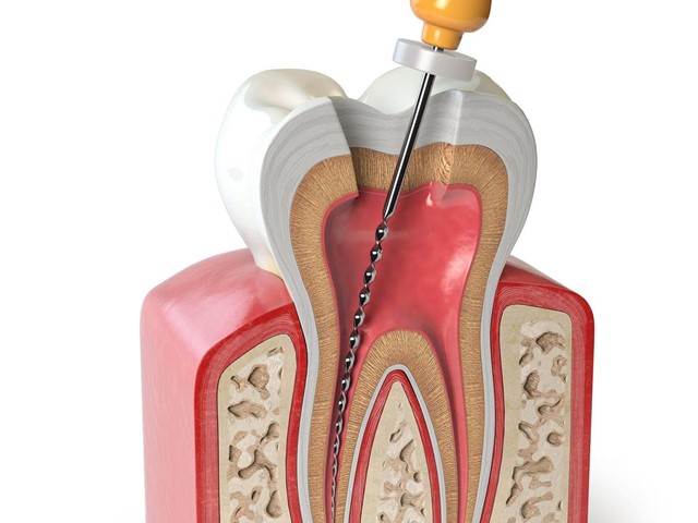 ¿Cuándo es necesaria una endodoncia y cuáles son sus beneficios?