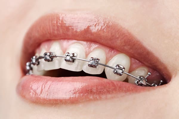 Ortodoncia fija o removible