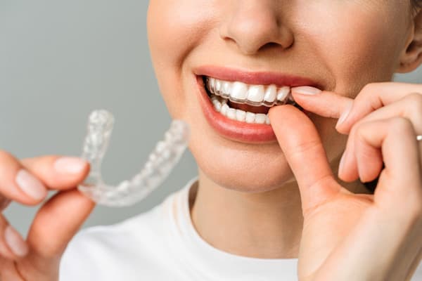 Sistema Invisalign