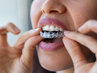 ¿La ortodoncia invisible duele?