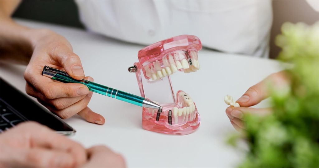 Qué hacer si se le cae un implante dental: pasos a seguir