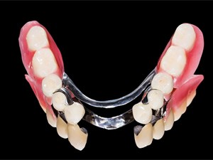 ¿Se pueden poner varias prótesis dentales a la vez?