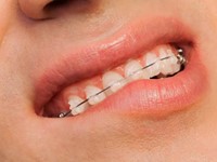 Tipos de brackets, ¿cuáles son los más adecuados para usted?
