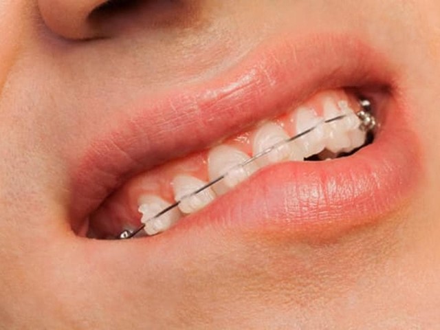 Tipos de brackets, ¿cuáles son los más adecuados para usted?
